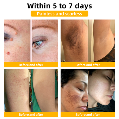 💥Only 4 boxes left! We are offering you an additional 30% OFF! Recommended by dermatologists, 4-6 boxes will restore your perfect skin! If you miss this opportunity, you'll have to wait until next year!